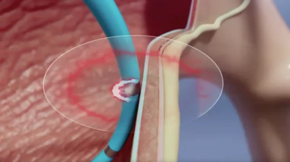 pulmonary hypertension denervation pulnovo medical