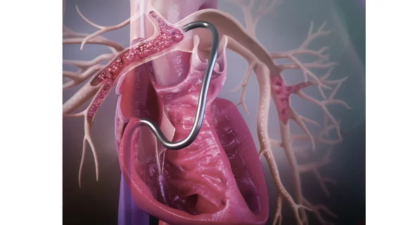 Jupiter Endovascular's Vertex Pulmonary Embolectomy System showed positive results in its SPIRARE II pivotal trial.