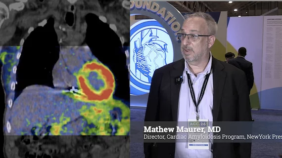 Video of Mathew S. Maurer, MD, director, Cardiac Amyloidosis Program, NewYork Presbyterian Hospital, explains how the American Hearty Association’s ATTR Amyloidosis Initiative is bringing together multidisciplinary teams to strengthen management of transthyretin amyloid cardiomyopathy (ATTR-CM). The goal is to catch more of these patients earlier and ensure they get timely care before they end up in advanced heart failure. #ATTR #Cardiacamyloidosis