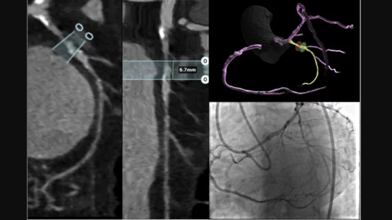 CCTA characterization of a chronic total occlusion with angiographic correlation during percutaneous coronary intervention.