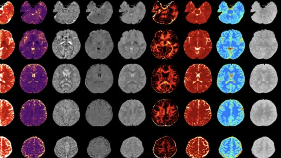 New MRI technique could improve diagnosis and treatment of MS
