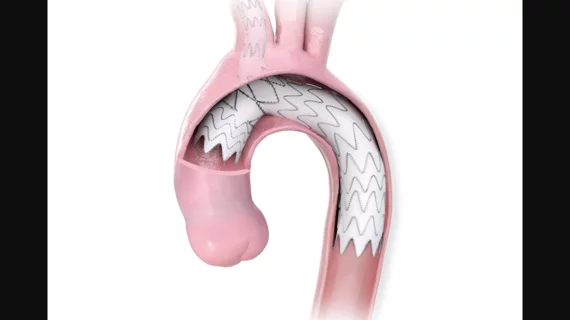 Nexus Aortic Arch System Artivion Endospan