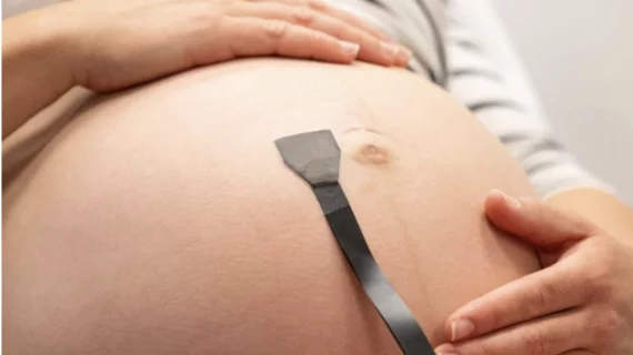 Wearable ultrasound patch continuously monitors pregnancies