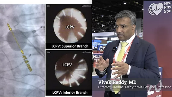 Video: Vivek Reddy, MD, Director, Cardiac Arrhythmia Service, The Leona M. and Harry B. Helmsley Charitable Trust Professor of Medicine in Cardiac Electrophysiology, Icahn School of Medicine at Mount Sinai, explains studies on the latest pulsed field ablation and leadless conduction pacing trials. #PFA #conductionpacing