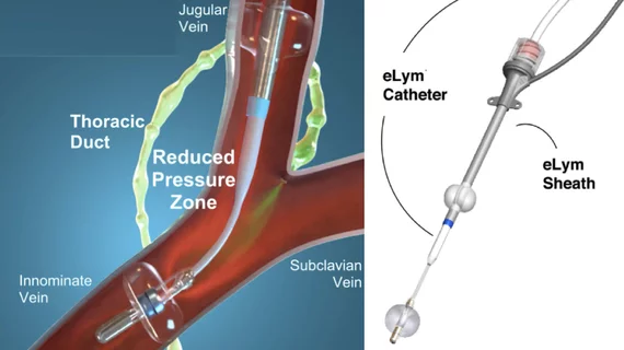 The WhiteSwell eLym catheter-based device for lymphatic drainage in acute decompensated heart failure (ADHF) patients.