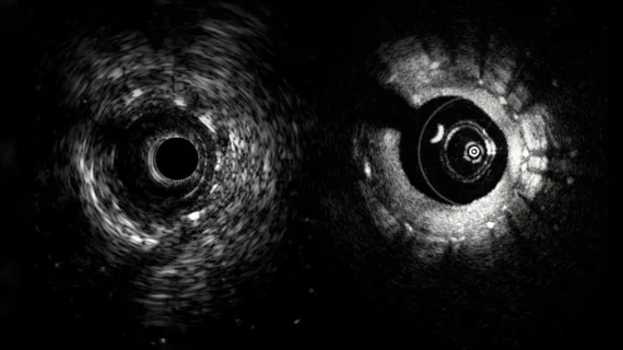 An example of the Novasight Hybrid System, showing its co-registered IVUS (left) and OCT intravascular imaging inside a coronary stent.