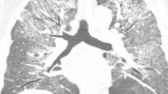 What hantavirus looks like on imaging