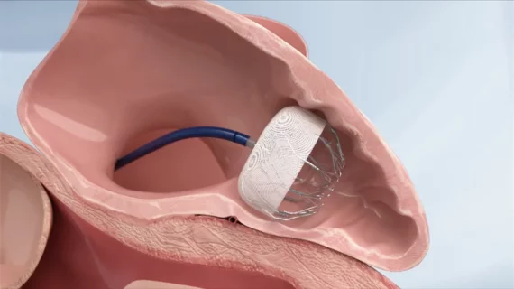 AnchorMan LAAC device MicroPort CardioFlow