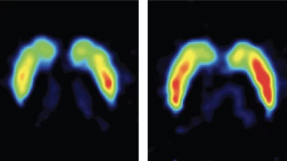 PET findings offer new hope for long COVID treatment