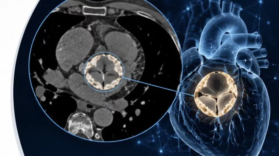Aortic stenosis opportunistic CT AI imaging from SCCT 2026 presentation by Ofir Koren, MD, Cedards-Sinai.