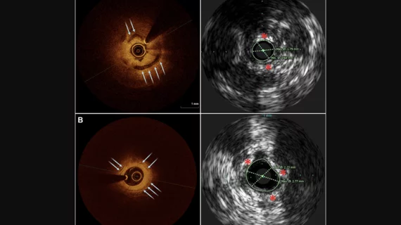 Examples of OCT (left) and IVUS (right) images of two different subjects with calcium. Blue arrows denote calcium noted on OCT, red asterisks mark calcium on IVUS