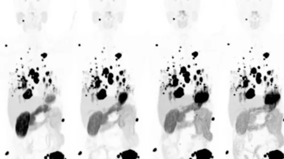 Theranostic pair shines at diagnosing and treating kidney cancer