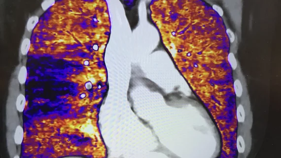 Deep learning spectral pulmonary embolism (PE) imaging displayed by Canon CT at RSNA.