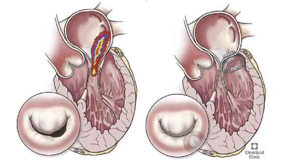 An illustration showing how the Mitria Medical Subvalvular Spacer (SVS) helps repair remodeling of the heart that distorts the valve and prevents proper leaflet closure due to functional mitral regurgitation (FMR). Structural Heart, April 2022, https://www.structuralheartjournal.org/article/S2474-8706(22)01273-8/fulltext.