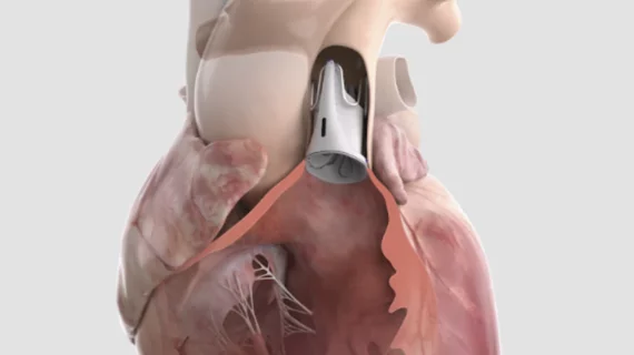 The Autus pulmonary heart valve is adjustable so it can grow with congenital heart patients as they age.