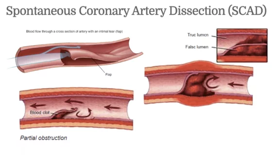 Spontaneous coronary artery dissection (SCAD) is a sudden tears in the wall of a coronary arteries can reduce blood flow and cause an uncommon type of heart attack, often in women. However, there is not a clear consensus on how to best treat this atypical cardiac presentation.