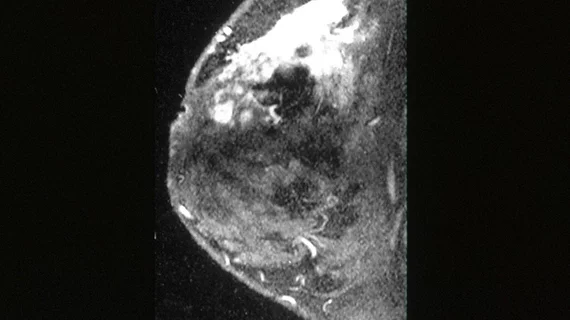 Breast MRI imaging