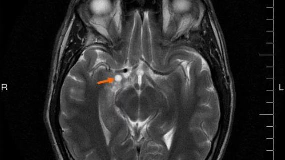 GliomaMRI.jpg Thumbnail
