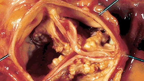 TAVR aortic stenosis aortic valve structural heart disease