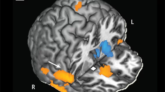 Functional MRI (fMRI) image measuring the strength of connectivity in particular brain circuits before and after subjects were given either a 20-milligram oral dose of methylphenidate used to treat ADHD or a placebo. The scans showed that methylphenidate strengthened connectivity between several brain regions involved in regulating emotions and exerting control over behaviors. Image courtesy of Brookhaven, Stony Brook, and the National Institutes of Health.